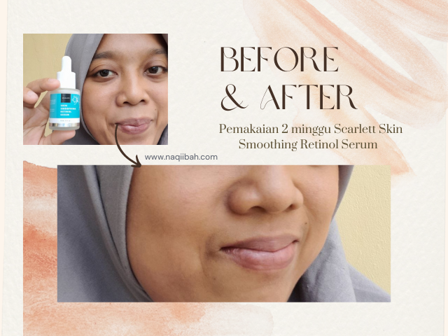 Review Setelah 2 Minggu Pemakaian Serum Retinol Scarlett