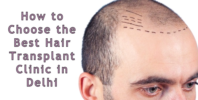 best hair transplant clinic in delhi