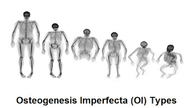 Osteogenesis Imperfecta (OI Disease): Types, Symptoms, Diagnosis And Treatment