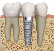 Dental Implant, Tooth Implant