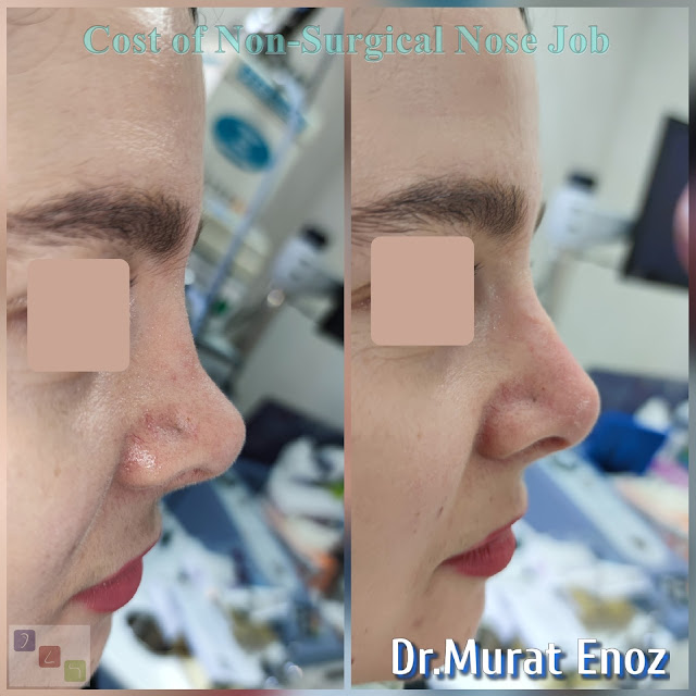 Cost of non-surgical rhinoplasty in Istanbul,Nose filler injection cost in Turkey,Cost of non-surgical nose job in Istanbul,Cost of non surgical nose job with filler in Istanbul,