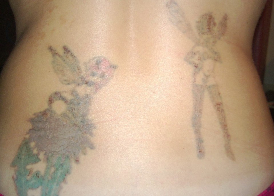 My tattoo removal process: Day 9 - Almost all healed! YAY