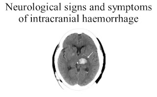 intracranial hemorrhage
