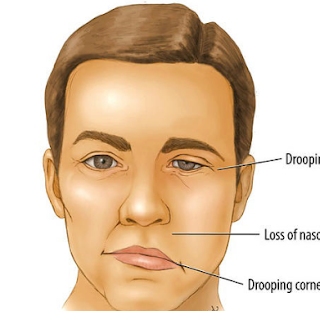 Fisioterapi BellsPalsy Surabaya