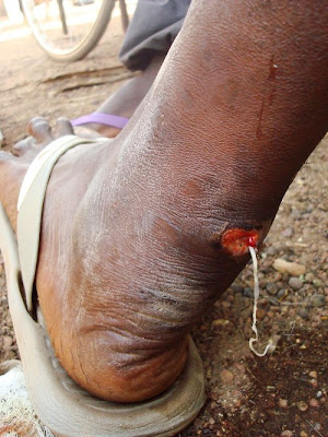 Rumah Unik Sederhana on Mengenal Cacing Guinea Yang Mengerikan   Situs Co   News Aggregator