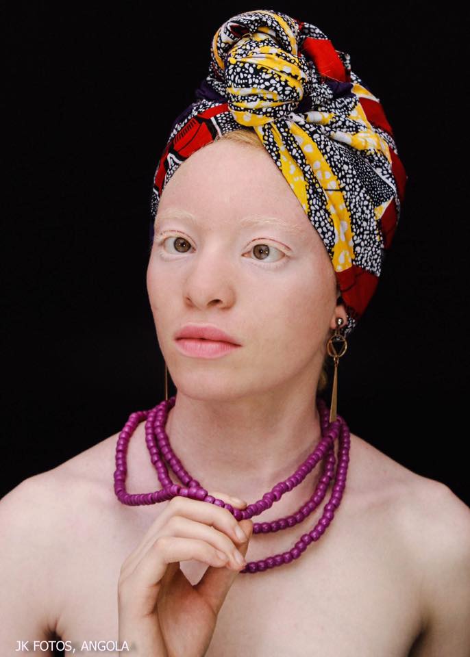 miss supranational angola 2018 winner strabismus albino albinism andreia muhitu