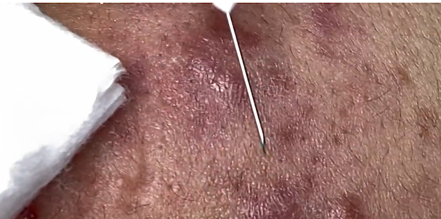 A Deep Dive into Acne Conglobata Popping & Natural Treatment at Home