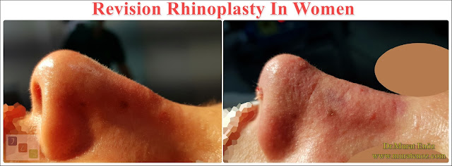 Revision Nose Job Surgery For Women in Istanbul - Revision Female Rhinoplasty in Istanbul - Women's Revision Rhinoplasty in Turkey - Revision Nose Reshaping For Women in Istanbul - Revision Nose Job Rhinoplasty For Women in Istanbul - Best Revision Rhinoplasty For Women Istanbul - Revision Nose Aesthetic For Women in Istanbul - Female Revision Nose Operation in Istanbul - Female Revision Rhinoplasty Surgery in Istanbul - Female Revision Rhinoplasty Surgery in Turkey - Female Revision Nose Aesthetic Surgery in Istanbul - Revision Rhinoplasty In Women Istanbul