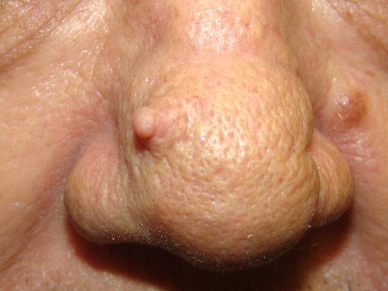 Cutaneous Horn of the Nose