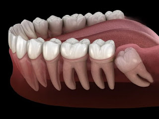 Răng khôn có phải răng số 8 không-1