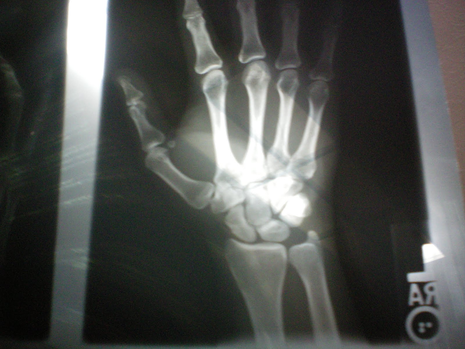 Hand x-ray. The break on my 4Th finger hand bone. See the black line on the 2ND to the top bone? That is my broken bone.