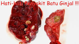 Bahaya dan Cara mengatasi penyakit batu ginjal