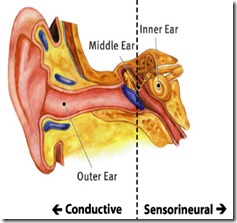 Sensorineural Loss