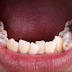 Quá trình niềng răng mọc lệch lạc mất bao lâu?