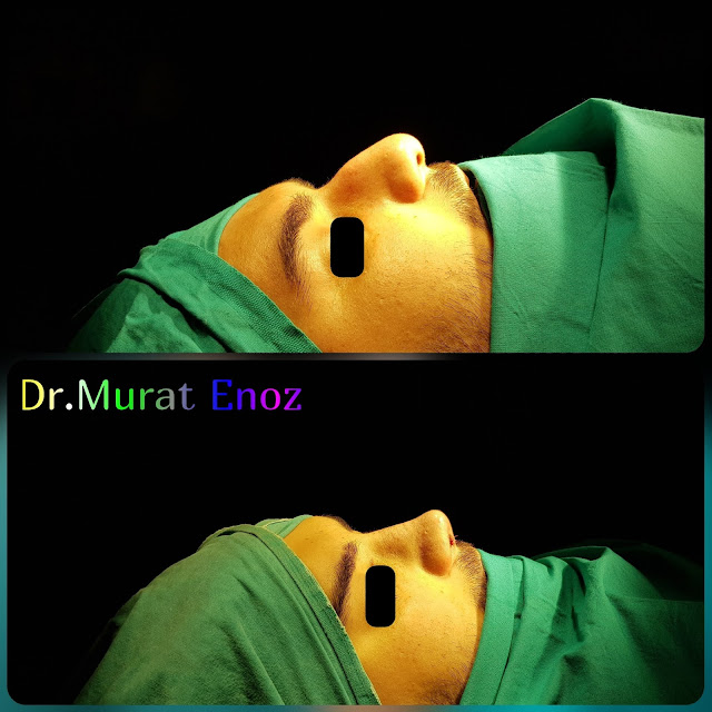 Rhinoplasty in men Istanbul, Male nose job Turkey. Nose aesthetic surgery for men