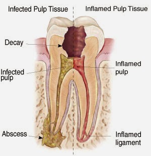 http://www.dental-clinic-delhi.com/root-canal-treatment.html