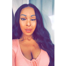 Acid attack survivor, Naomi Oni shares lovely new photos