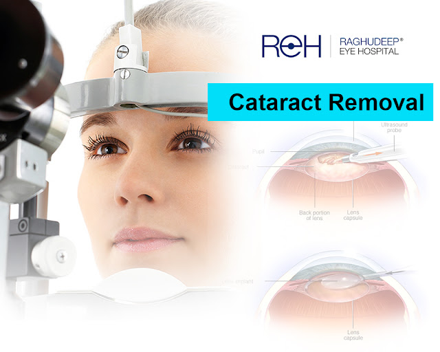 Cataract Removal In Jaipur