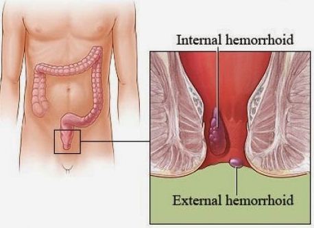 pengobatan hemoroid 