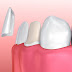 Bọc răng sứ có ảnh hưởng gì đến sức khỏe?