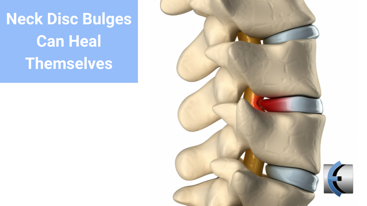 Neck Disc Bulges Can Heal Themselves - themanualtherapist.com