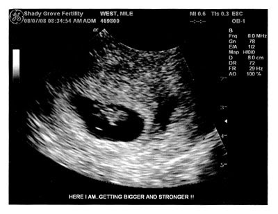 ultrasounds at 6 weeks. Then I#39;ll have an ultrasound