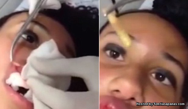 Worm Larvae Pulled From Girls Lips