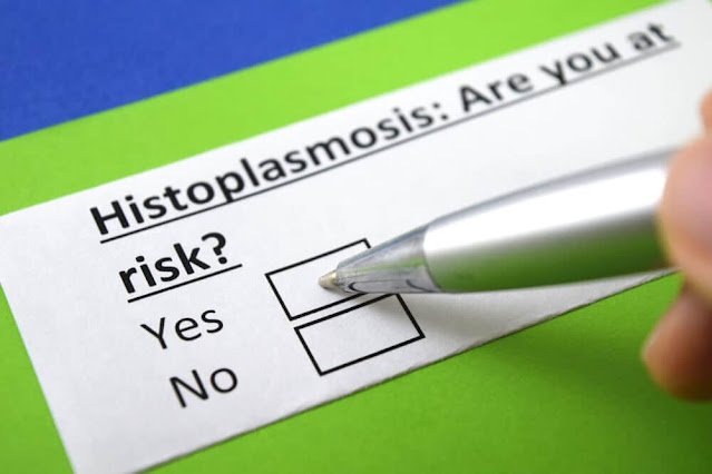 Understanding Histoplasmosis of the Eye: Symptoms, Diagnosis, Treatment, and Prevention