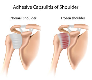 Frozen shoulder