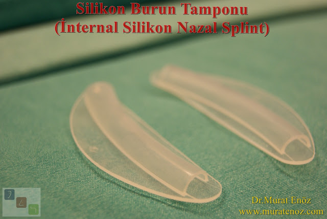 When will the internal nasal silicone splints be removed after a septoplasty operation? - How many days after the operation of the septoplasty the internal nasal silicone splints are removed? - When will the internal nasal silicone splints be removed after the septoplasty operation? - When is internal nasal silicone splints are removed after nasal septum deviation correction surgery?