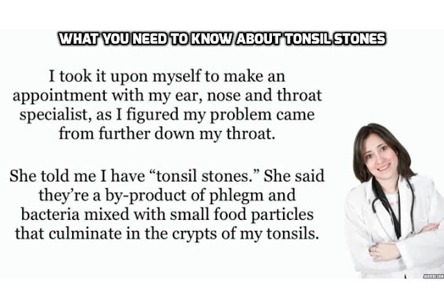 Tonsil stones, also known as tonsilloliths, are caused by the accumulation of debris in the crevices of your palatine tonsils. These lymphatic organs are located on either side of the back of your throat. If you suspect that you may have tonsil stones, you can perform a simple at-home throat examination with a few supplies. 