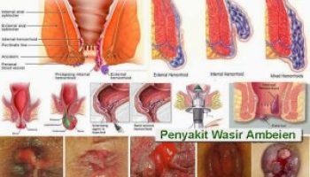 obat wasir tradisional