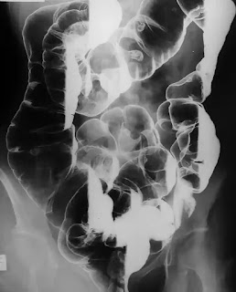 barium enema in radiology