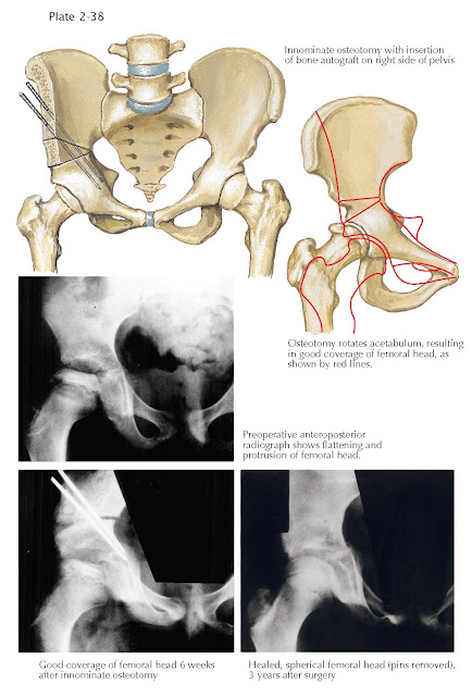 INNOMINATE OSTEOTOMY