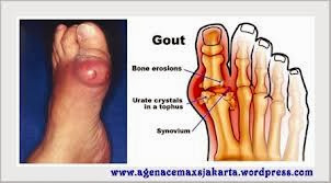 Cara Obati Penyakit Asam Urat