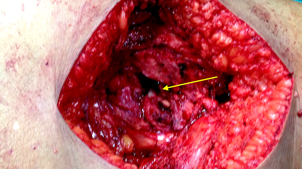 Anterior interosseous nerve Injury