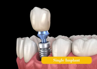 dental implant one