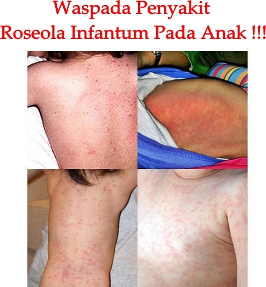 Obat Tradisional Roseola Infantum Anak