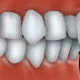 Phương pháp điều trị răng hô an toàn hiệu quả