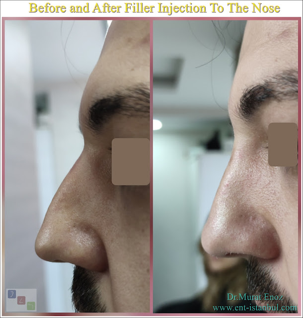 limited filler injection to the nose,Non surgical nose job with filler,