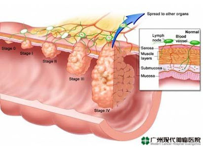 metode diagnosa untuk kanker usus besar