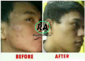 OBAT-JERAWAT-BATU-AMPUH-DAN-CEPAT-repellent-acne