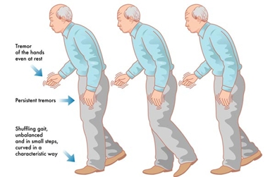 Pengobatan Herbal Parkinson Aman Dan Ampuh