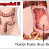 Cara Alami Menyembuhkan Tumor Pada Usus Besar Tanpa Operasi