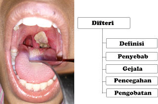 Awas Bahaya Penyakit Difteri (Infeksi Tenggorokan dan Hidung)!