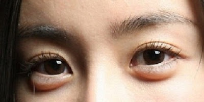 8 Tips alami Mengatasi Kantung Mata (Eye Bag)