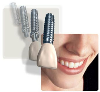 implantes dentales