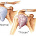 Physiotherapy dan Cara senaman serta rawatan Frozen Shoulder