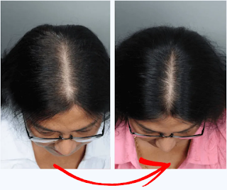 hair loss treatment for women | hair loss treatment for women remedies | hair loss treatment for women products | hair loss treatment for women vitamins | hair loss treatment for women shampoos | hair loss treatment for women natural | hair loss for woman|hair loss remedy|hair loss treatment | Hair loss remedy women|hair loss|hair loss remedy|hair loss after pregnancy|hair loss treatment|Hair |