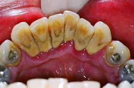 Karang Gigi Hitam dan Cara Menghilangkannya